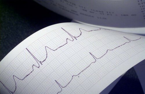Расшифровать кардиограмму сердца самостоятельно