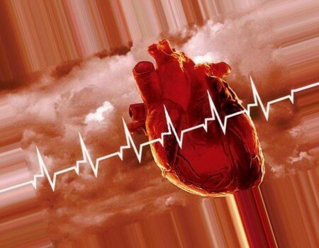 стадия инфаркта миокарда