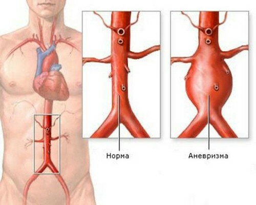 схема аневризмы аорты