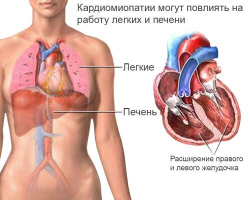 влияние дисгормональной кардиомиопатии на другие органы
