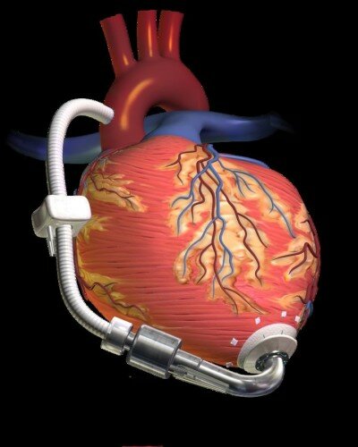 кардиостимулятор установлен на сердце